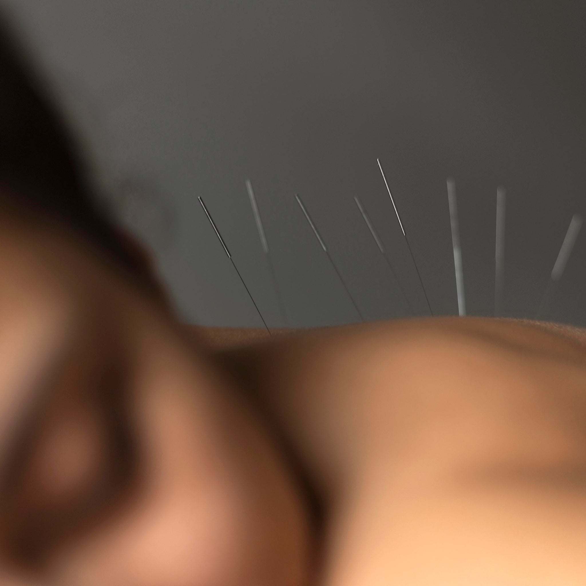 Can Acupuncture Points for Tinnitus Stop the Ringing?